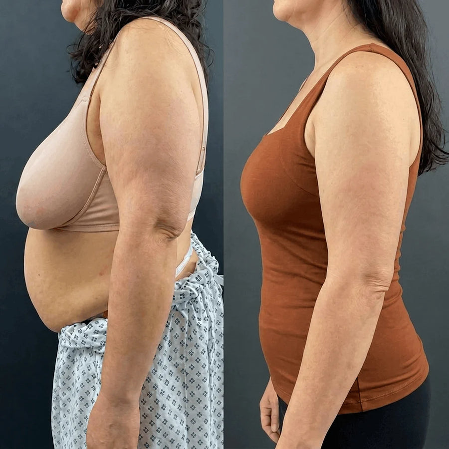 Lorena M. — antes y después